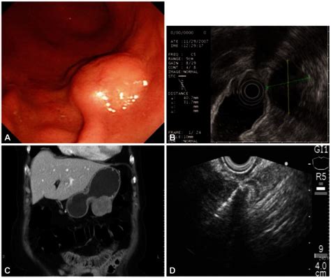 (A) Gastroscopy shows a submucosal elevated lesion with bridging fold ...