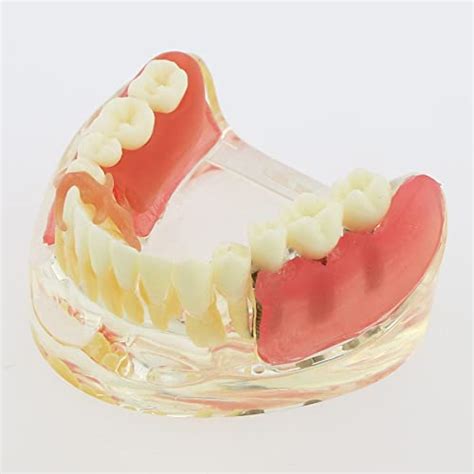 Dental Implant Typodont Restoration Teeth Model M Overdenture