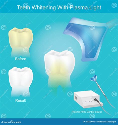 Teeth Whitening With Plasma Light Stock Vector Illustration Of Plasma