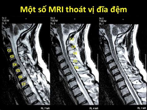 Trường Hợp Nào Chỉ định Chụp Mri Cột Sống Thắt Lưng P2