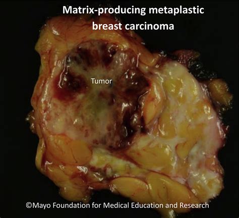 Metaplastic Breast Cancer Mayo Clinic Proceedings