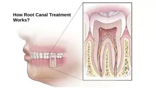 PPT How To Take Care Of Your Tooth After Root Canal Treatment