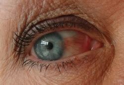 Pterygium a Degenerative or Inflammatory Process