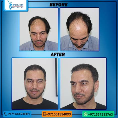 Best Hair Transplant In Dubai Tunio Aesthetics Artofit