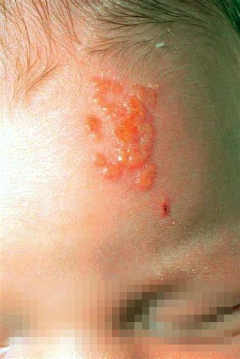 Pin On Dermatology Images