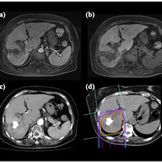 HCC In An 83 Year Old Female Patient Treated With C Ion RT A MRI