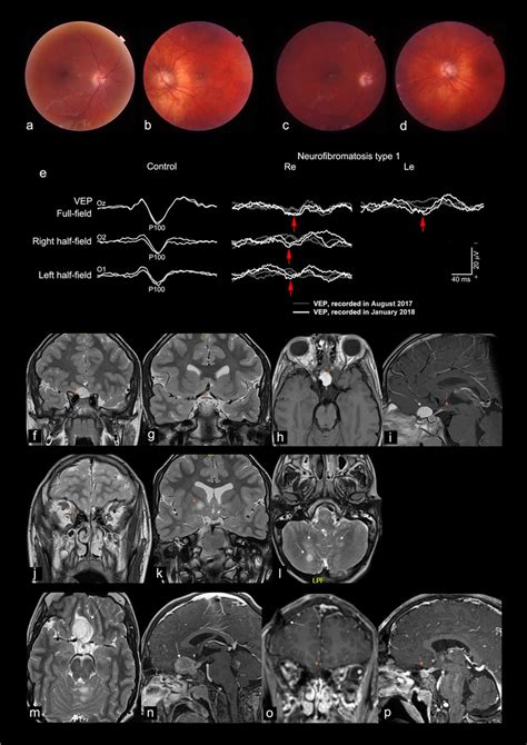 Case 3. Optic discs appearance before operation right eye (a), left eye... | Download Scientific ...