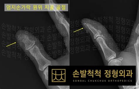 손발척척 정형외과 수술센터 수술센터 수술센터 손톱손상을 동반한 손가락 골절의 봉합과 고정수술