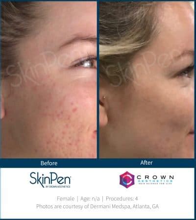 Skinpen Microneedling Collagen Induction Therapy Skin Renu