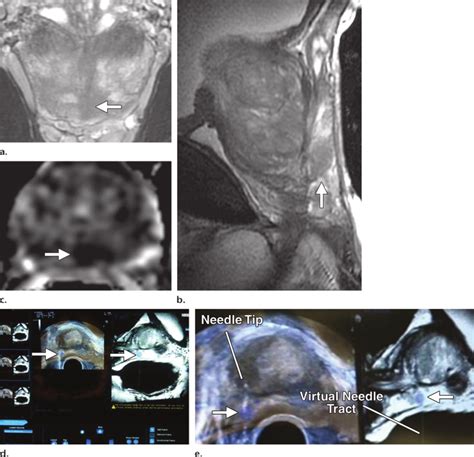 Fused Mr Imaging And Transrectal Usguided Prostate Biopsy In A Download Scientific Diagram