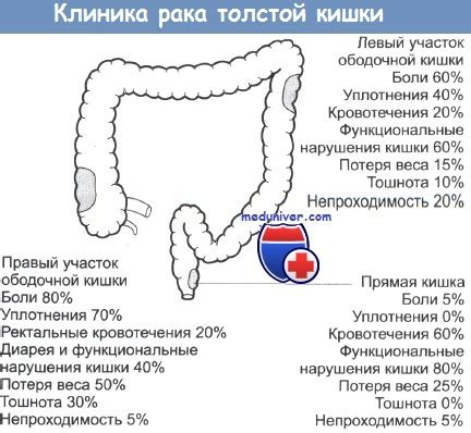 Колоректальный рак (КРР) - рак ободочной кишки