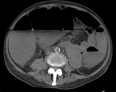 Toxic Megacolon – Undergraduate Diagnostic Imaging Fundamentals