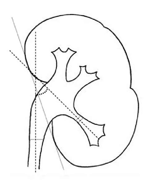 Nfundibulopelvic Angle Described As The Angle Between The Line