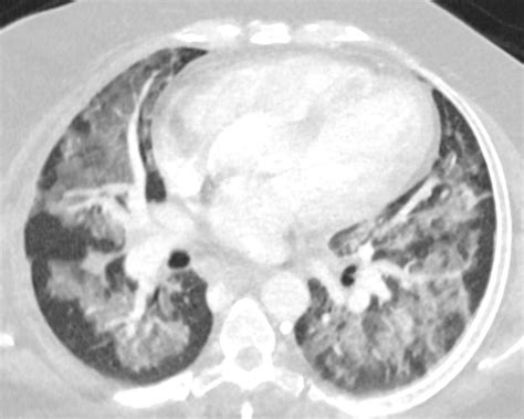 171Lu Acute Inhalational Crack Injury | Lungs