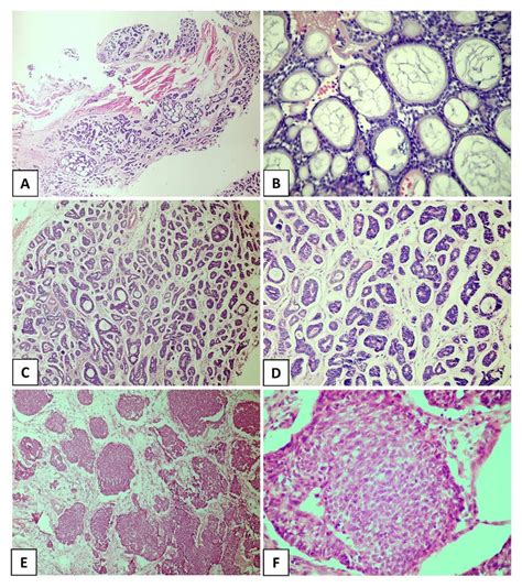 Histological Subtypes Of The Salivary Gland Adenoid Cystic Carcinoma