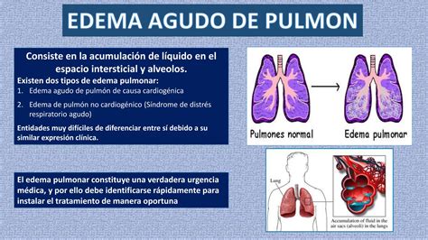 EDEMA AGUDO DE PULMON PPT