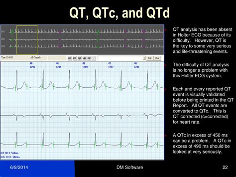 Ppt Reading The Holter Ecg Report Powerpoint Presentation Free