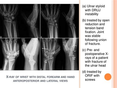 Distal Radioulnar Joint Injuries Druj And Carpal Instability