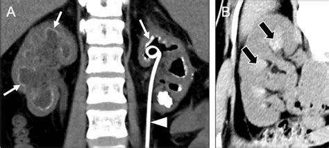 Mimics Of Medullary Nephrocalcinosis Coronal Non Contrast Ct Image A