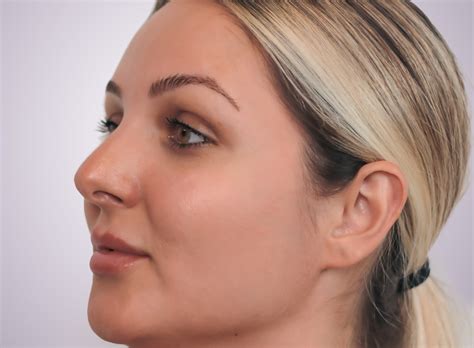 4 Best Treatments For Nasolabial Folds Smile Lines Mov More Clinic
