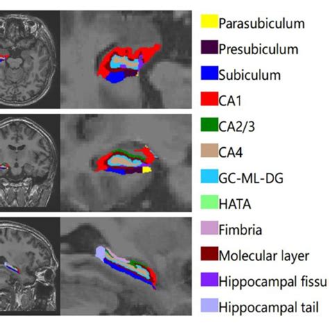 A Simple Of Left Hippocampal Subfield Automated Segmentation