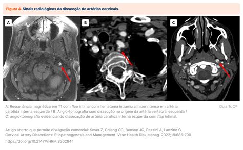 Diretriz de Dissecção de Artérias Cervicais 2024 AHA ASA Guia TdC