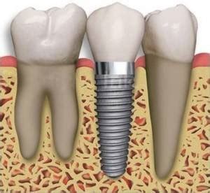 Implantes De Ltima Tecnolog A Valencia Cl Nica Dental Almar