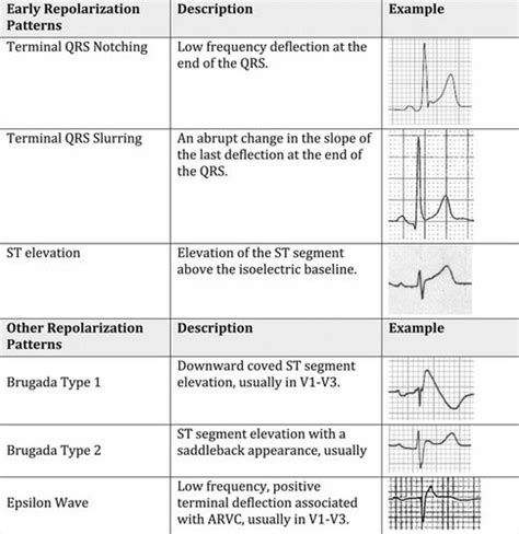 Electrocardiographic Early Repolarization Circulation