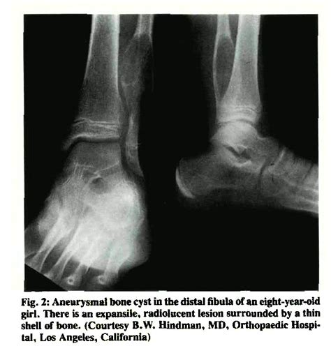 Aneurysmal Bone Cyst