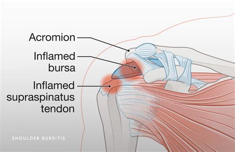 Inflamed Shoulder Tendons