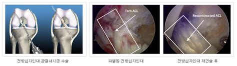 전방십자인대