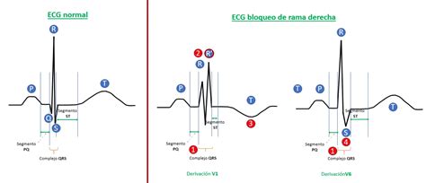 Bloqueo Completo De Rama Derecha Causas S Ntomas Y Tratamiento