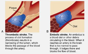 Cognition Tia Strokes Flashcards Quizlet