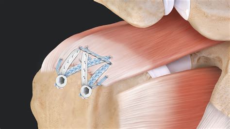 Arthrex Compression Speedbridge™ Rotator Cuff Repair