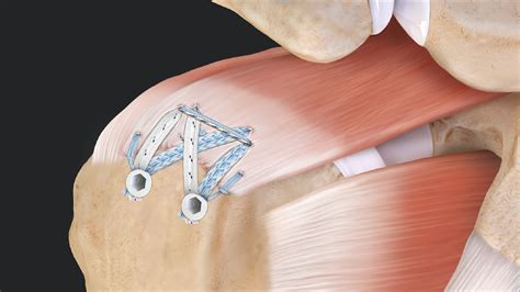 Rotator Cuff Surgery Gold Coast At Thomas Black Blog