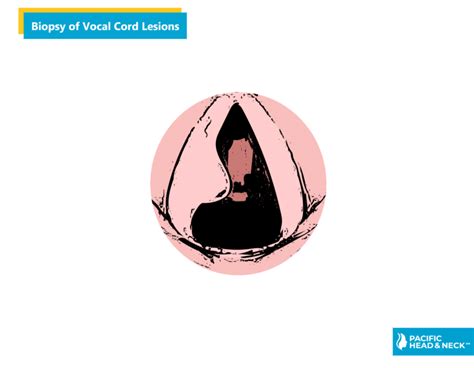 Biopsy Of Vocal Cord Lesions Pacific Head Neck