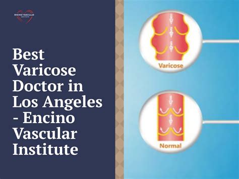 Ppt Best Varicose Doctor In Los Angeles Encino Vascular Institute