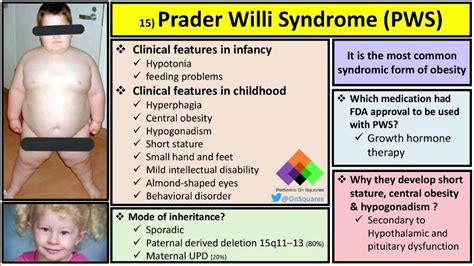 Prader Willi Syndrome Causes Risks Clinical Features Diagnosis Management Youtube