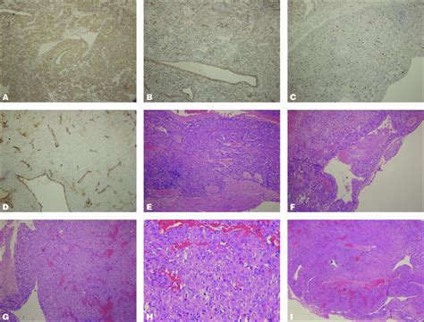 A D Immunohistochemical Staining Of Pathological Sections The Tumor