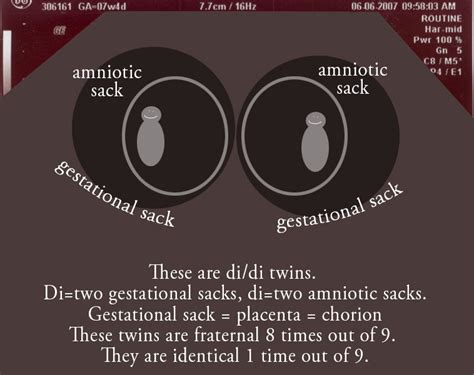 Types Of Twins And Triplets Pyjammys Identical Triplets