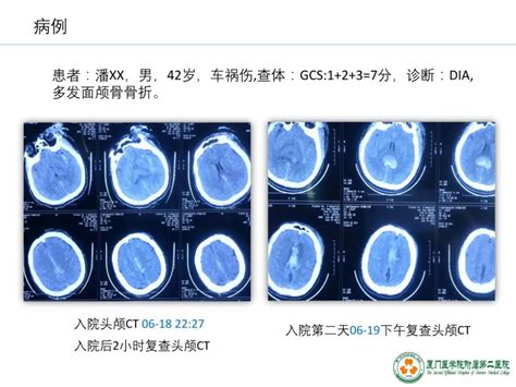 监测有道丨弥漫性轴索损伤并发脑室积血颅内压监测一例——颅脑创伤 神经重症周刊（第196期） 脑医汇 神外资讯 神介资讯