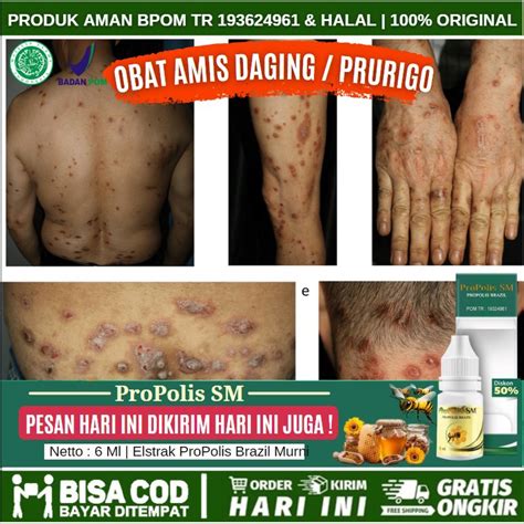 Jual Obat Penghilang Gatal Kulit Prurigo Untuk Anak Dan Dewasa Obat