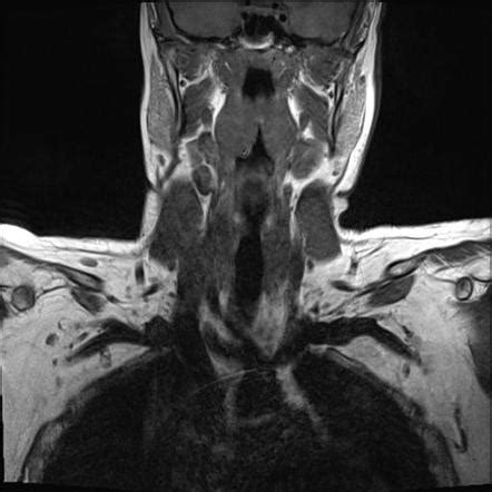 Brachial Plexus Traction Injury Radiology Case Radiopaedia Org