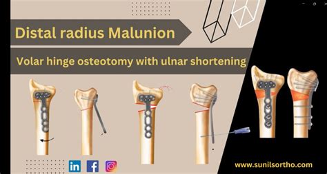 Volar Osteotomy For Distal Radius Malunion Orthopaedicprinciples