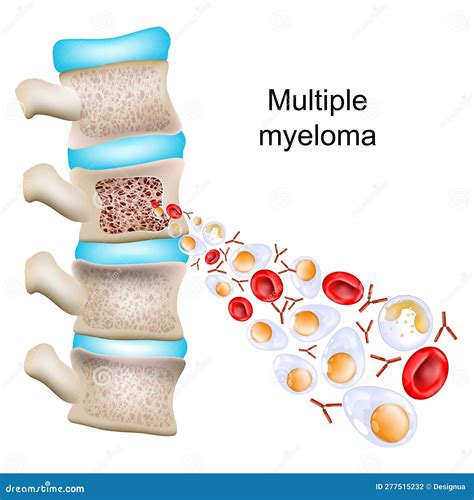 Multiple Myeloma. Close-up of Abnormal Plasma Cells, Red Blood Cells ...