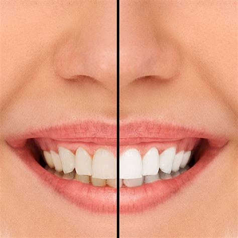 How Cosmetic Dentistry Treatments Can Help A Gummy Smile Smiles By