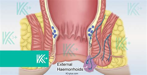 External Hemorrhoids Treatment