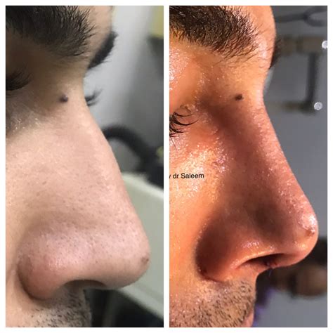 Rhinoplasty Cost In Pakistan Lahore Cosmetic Nose Job Surgery