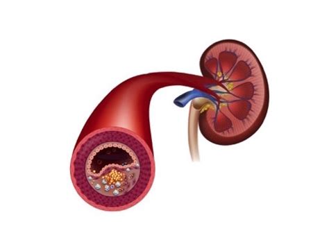Obstrução De Artérias Renais Dra Nayara