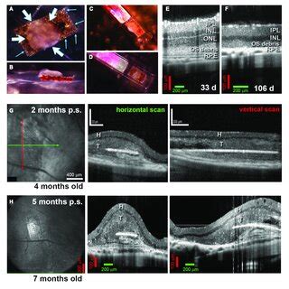 Retina Organoid Rpe Implant On Matrigel A Ro And Rpe Embedded